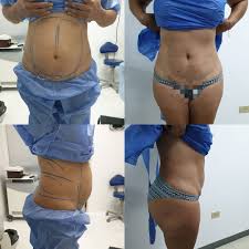 Liposuccion De Abdomen Y Flancos Con Anestesia Local Un Mes De Evolucion Citas Por El 684188822 Abdomen Evolucion
