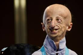 Omim #176670) is a very rare genetic disease, characterized by precocious ageing in early infancy. Old Before His Time The Man Researching His Own Premature Ageing Condition The Gryphon