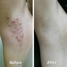 Tend Skin Care Solution Shaves Your Usual Spending In Half When It Comes To Nixing Ingrown Hairs And Razor Bumps Ingrown Hair Ingrown Hair Remedies Tend Skin