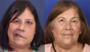 Contemporary techniques for nerve transfer in facial reanimation