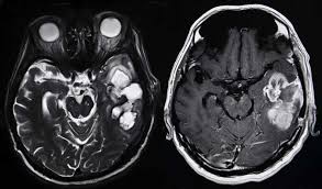 Meningioma tumors are often benign: Brain Tumor Causes Aren T Always Clear University Health News