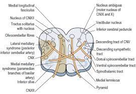 Anatomical Basis Of Wallenberg Lateral Medullary Syndrome Mnemonic Epomedicine