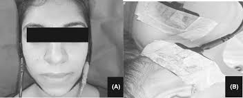 RETRACTED: Comparative effectiveness of low‐level laser therapy and  transcutaneous electrical nerve stimulation in symptomatic  Temporomandibular Disorders: A Randomised Control Trial