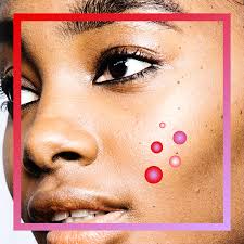 Entdecke rezepte, einrichtungsideen, stilinterpretationen und andere ideen zum ausprobieren. How To Get Rid Of Stress Acne Glamour
