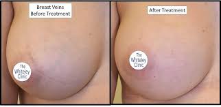 Suddenly her breast looks bigger and fuller. Breast Veins And Chest Veins Treatment The Whiteley Clinic