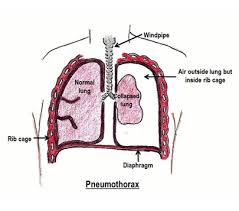 Understanding the structure of your lungs and the protective membrane that surrounds them can when a traumatic injury happens during a medical procedure, it's called an iatrogenic. Pneumothorax Spontaneous