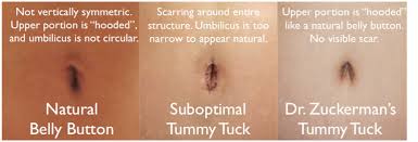 Image result for Umbilicus