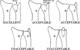 The extensor carpi ulnaris muscle originates from the outer side of elbow on the lateral epicondyle of humerus and traverses down the forearm and enters the base of the small finger. Validation Of The Extensor Carpi Ulnaris Groove As A Predictor For The Recognition Of Standard Posteroanterior Radiographs Of The Wrist Journal Of Hand Surgery