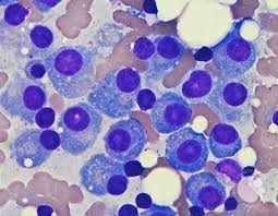 Image result for Multiple Myeloma