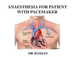 The pacemaker's leads will be inserted into the subclavian vein and then threaded toward the right side of your heart. Anaesthesia For Patient With Pacemaker