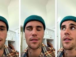 Wie ihr an meinem Gesicht sehen könnt“: Justin Bieber leidet nach Virus an  gelähmter Gesichtshälfte