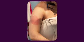 Moderna's vaccine is causing a rash on some people's arms after injection. Covid 19 Vaccine Delayed Skin Reaction Redness Rash A Week After Shot