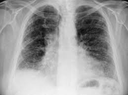 Rheumnow Interstitial Lung Disease Not Increased With Biologics Medpage Today