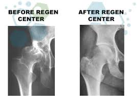 Hip replacement surgery and hip resurfacing are often the only surgical options presented to a patient to deal with their debilitating pain, though hip the innovative regenexx procedures restore hip function and mobility and decrease pain without the need for surgery by regenerating damaged. Stem Cell Therapy For Hips Thighs Avn Osteonecrosis
