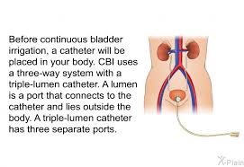 Image result for Continuous Bladder Irrigation