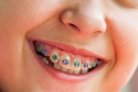 Il centro odontoiatrico giannini di monza ed è uno studio dentistico specializzato in implantologia chirurgida, ortodonzia e sbiancamento dentale. Nuovi Apparecchi Per Malocclusione E Denti Non Allineati Guida Genitori