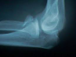 Image result for Coronoid Process Fracture
