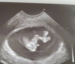 Durch den ultraschall erkennt dein gynäkologe jetzt auch das geschlecht des babys. Wirklich Junge Ssw 12 Schwanger Wer Noch