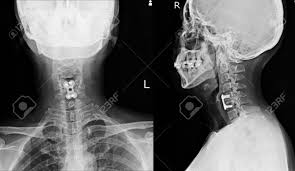 It's commonly done after someone has been in an automobile or other accident. C Spine X Ray Lateral And Ap Views A Female 56 Year Old Normal Cervical Spine And Post Operation With Plate And Screws In C5 C6 Stock Photo Picture And Royalty Free Image Image 137054745