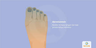 Saya juga ingin bertanya apakah risiko jika suhu badan bayi saya tidak normal? Akrosianosis Tanda Dan Gejala Penyebab Cara Mengobati Cara Mencegah