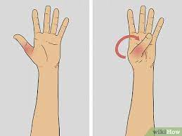 Thumb fractures can range from fairly straightforward, clean breaks all the way to multiple fractures along a joint that require surgery to repair. How To Diagnose A Broken Thumb 15 Steps With Pictures Wikihow