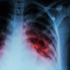 Tb or tb may refer to: Tuberculosis Tb Tb Test Medlineplus