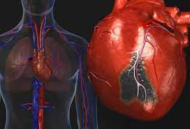 Presence of airway edema and mucus secretion also contributes to airflow obstruction and bronchial reactivity. 5 Types Of Heart Disease Symptoms Early Signs Treatment Causes