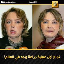 أول عملية زراعة وجه في العالم منذ 12 عاما تمكن فريق من الجراحين الفرنسيين من إتمام عملية نقل زراعة وجه ولكن لسوء الحظ وبعد مرور سبع سنوات رفض جسد المريض acl