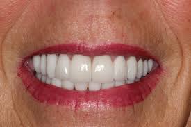 Not Happy With My Invisalign Results (More In Comments) : R/Invisalign