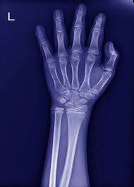 Image result for Scaphoid Fracture Signs