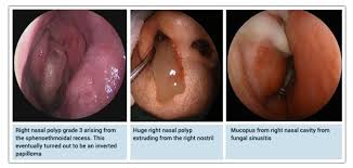 Image result for Sinus Surgery