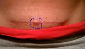 It tends to appear after hair removal by shaving or waxing and can affect both male and female persons. Ingrown Pubic Hair Infected Cyst Bump Get Rid Remove Prevent Stop Boil Hard Lump Pus Remedies