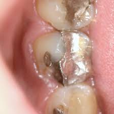 Check spelling or type a new query. Should You Replace Old Black Fillings With White Fillings