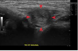 Image result for Inguinal hernia child