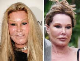 Jocelyn Wildenstein Cat Woman Plastic Surgery Before After Celebrity Plastic Surgery Celebrity Surgery Plastic Surgery Celebrity Plastic Surgery