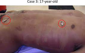 The axon taser® is the best shooting stun gun on the market. Taser Electronic Control Devices Can Cause Cardiac Arrest In Humans Circulation