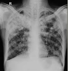 Tuberculosis Lung X Ray Tuberculosis Pulmonary Hospital