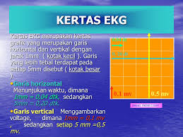 We did not find results for: Ekg Normal Ima Aritmia Yang Mengancam Nyawa Ppt Download