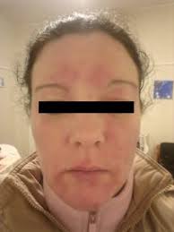 The Results of Eczema Treatment for a 40-Year-Old Female