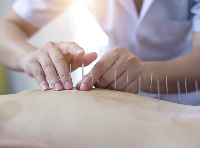 Dry Needling Therapy product image