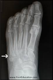 What is the recovery time of a broken ankle? 5th Metatarsal Avulsion Fracture Footeducation