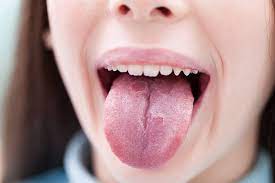 Enfermedades De La Lengua Banco De Fotos E Imagenes De Stock Istock