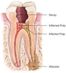 Click on the different category headings to find out more and change our default settings. Root Canal Treatment American Association Of Endodontists