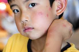 How Long Do Bed Bug Bites Last Terminix