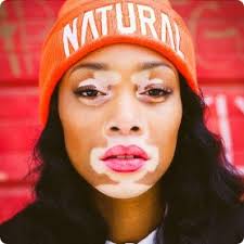 Vitiligo Research Foundation