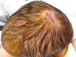 Image result for Cradle Cap