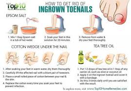 Home Remedies For Ingrown Toenails Top 10 Home Remedies Ingrown Toe Nail Toe Nails Home Remedies