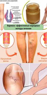 как лечить варикоз на ногах у женщин в домашних условиях Chego Boitsya Varikoz Effektivnye Narodnye Metody Lecheniya V 2020 G Varikoz Zhurnal O Zdorove Sovety