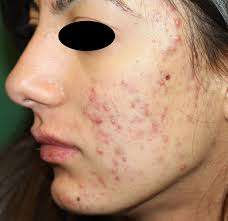 Isotretinoin is available only from a certified pharmacy under a special program called ipledge. Acne Vulgaris Intechopen