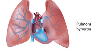 Image result for Cor Pulmonale